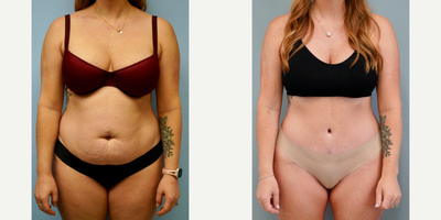 25-34 year old woman treated with Tummy Tuck - Full abdominoplasty with flank liposuction