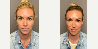 45-54 year old woman treated with Dermal Fillers, Restylane Lyft, Restylane, Cheek Lift - Under eye filler.