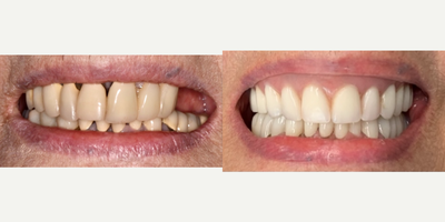 75 and up year old woman treated with Dental Implants - Immediate implants with teeth