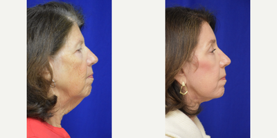 3478 Facelift, TCA Peel, Blue Peel, Brow Lift - 65-74 year old woman treated with Facelift, TCA Peel, Blue Peel, Brow Lift
