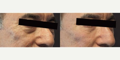 55-64 year old man treated with Juvederm, Volbella, Voluma, Restylane, Restylane Contour - 4D Under Eye Lift - Treatment of dark circles & bags under eyes and cheek restoration with Belotero, Restylane, Volbella and Voluma