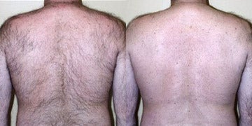 Laser Hair Removal