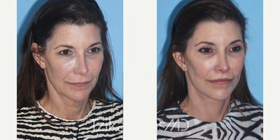55-64 year old woman treated with Facelift - Deep Plane Facelift, Temporal Brow Lift, Upper Blepharoplasty, Lip Lift, Platysmaplasty & eCO2 laser of lower eyelid skin.