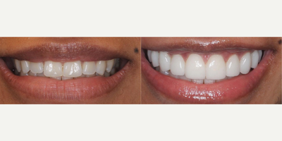 Woman treated with Teeth Whitening - Woman treated with Teeth Whitening as well as 10 minimal/no-prep veneers and laser gum recontouring