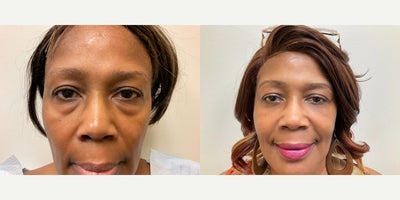 Woman treated with Eyelid Surgery - 1 month post lower Blepharoplasty