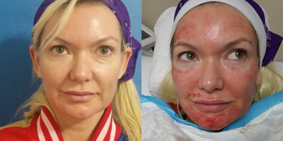 35-44 year old woman treated with Vampire Facelift - PRP + Microneedling one effective treatment to rejuvenate skin, improve scars and pores. It is a natural anti-aging procedure and to prevent aging.