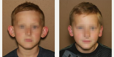 6 years old man treated with Ear Surgery - 6 years old man treated with Ear Surgery