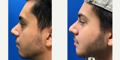 18-24 year old woman treated with Chin Implant - Chin implant on this young man to create a more symmetrical, protruding chin.