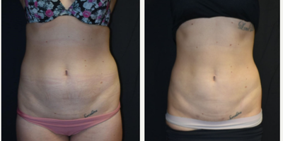 Woman treated with Liposuction - Woman treated with Liposuction