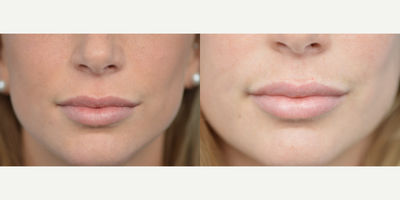 25-34 year old woman treated with Lip Augmentation - This patient wanted plumper more fuller lips. Our non-surgical lip filler helped her achieve her goals.