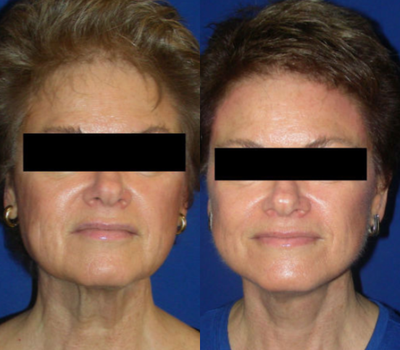 55-64 year old woman treated with Lower Face and Neck Lift and Endoscopic Brow Lift - Lower Face and Necklift; Endoscopic Brow Lift performed