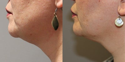 45-54 year old woman treated with Kybella, Vampire Facial - 54 yo female with complaint of under the chin fat collection, successfully treated with in office Kybella and Vampire Neck Series!