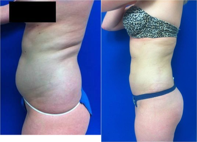 Laser Liposuction -
Laser Liposuction