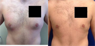 Laser Liposuction -
Laser Liposuction