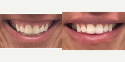 25-34 year old woman treated with Botox for Gummy Smile - Botox for gummy smile