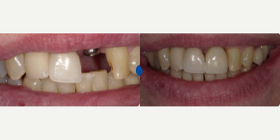 Woman treated with Smile Makeover - Woman treated with Smile Makeover