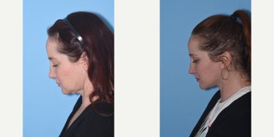 45-54 year old woman treated with Lower Facelift, Neck Lift - My lovely 44 year old patient did not like the looseness of her neck skin and muscle. The neck ages earlier than the face because the skin is much thinner and lacks good elasticity. Some patients necks age earlier than others based on many factors, such as environmental exposure and genetics. My patient wanted to nip this problem in the bud before her neck relaxed even more. She has a gorgeous neck and jawline result after a deep plane facelift and neck lift, platysmaplasty and is extremely happy. This result should last at least 10 years.