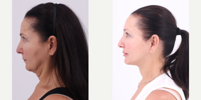 55-64 year old woman treated with Facelift, Neck Lift, Buccal Fat Removal - 60 year old patient 6 months after Facelift, Neck lift and Buccal Fat Removal