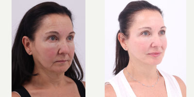 55-64 year old woman treated with Facelift, Neck Lift, Buccal Fat Removal - 60 year old patient 6 months after Facelift, Neck lift and Buccal Fat Removal
