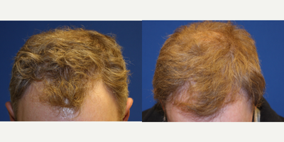 35-44 year old man treated with Hair Transplant - 41 year old patient who underwent FUE hair transplant procedure. He received about 1,500 grafts mainly to the frontotemporal recession to achieve natural frontal hair line.