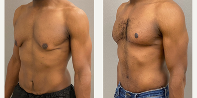 25-34 year old man treated with Male Tummy Tuck, Gynecomastia Surgery, Masculinizing Top Surgery - 30 yo male s/p modified mastopexy for gynecomastia after massive weight loss and male tummy tuck performed in our on site AAAA certified operating suite