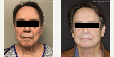 55-64 year old man treated with Renuvion - Patient unhappy with cosmetic appearance of face. The patient was interested in alternatives to Full or Mini Facelift and informed patient about the Renuvion (JPlasma) procedure.Patient has diagnosis of Ehlers-Danlos syndrome confirmed by skin biopsy performed by dermatologist in the past. Ehlers-Danlos syndrome (EDS) is a group of hereditary connective tissue disorders characterized by defects of collagen in the body. Collagen is a tough, fibrous protein, that plays an essential role in holding together, strengthening, and providing elasticity to bodily cells and tissues. Due to defects of collagen, primary EDS symptoms and findings include unusually loose, thin, stretchy (elastic) skin; and excessive fragility of the skin, blood vessels, and other bodily tissues and membranes.