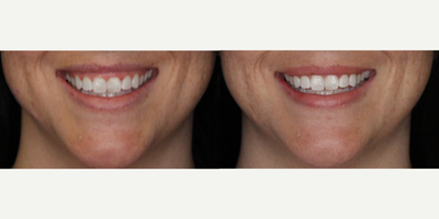 Botox Lip Flip for this 34-year-old Woman - This 34-year-old female had 4 units of Botox injected to relax the muscles that raise her lower lip, thereby decreasing her gummy smile. She is thrilled with her results!