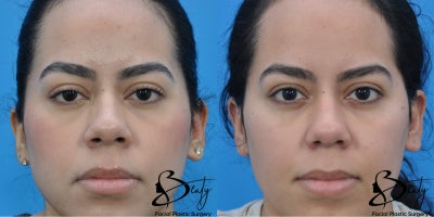 25-34 year old woman treated with Alarplasty - 25-34 year old woman treated with Alarplasty using weir excisions