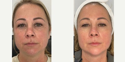 35-44 year old woman treated with Microneedling - She came in concerned with her fine lines and wanted a solution. We suggested a microneedling treatment and she was very pleased with the results.