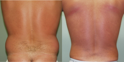 25-34 year old man treated with Liposuction - This patient underwent liposuction of the flanks
