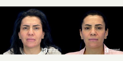 45-54 year old woman treated with Dysport - The patient is a 46-year-old female with concerns about fine lines and wrinkles. Dr. Chiang used wrinkle relaxer (Dysport or Chotox) for the forehead, crow's feet, bunny lines, masseters, and neck bands to address these concerns. The after results are 2 weeks post-treatment.