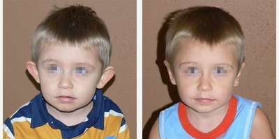 Man treated with Ear Surgery - Man treated with Ear Surgery