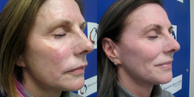 45-54 year old woman treated with IPL - sun damage and rosacea before and after