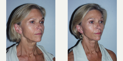 Woman treated with Facelift - Woman treated with Facelift