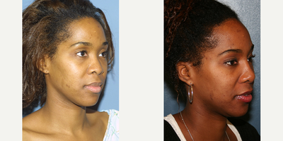 Woman treated with Rhinoplasty - Woman treated with Rhinoplasty