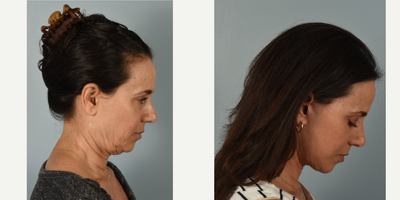 55-64 year old woman treated with Facelift, Neck Lift, Fractional Laser - This patient had the following procedures: mini facelift, neck lift, and fractional CO2 laser. After photos are 3 months post op.