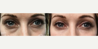 Woman treated with Belotero, Dermal Fillers, Hyaluronidase - Woman treated with Belotero, Dermal Fillers, Hyaluronidase