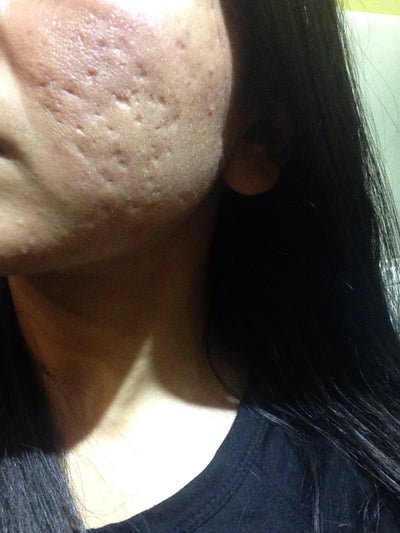 I'm 21 yr old girl with naturally tan skin with deep acne I'm 21 yr old girl with naturally tan skin with deep acne