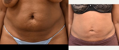 40 year old woman treated with Smart Lipo - Smart Lipo Abdomen