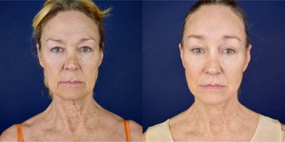65-74 year old woman treated with Deep Plane Facelift, Neck Lift, Brow Lift, Eyelid Surgery, Canthoplasty, Lip Lift, Facial Fat - This female patient had a previous upper and lower eyelid surgery and forehead lift 10 years ago. She had a wrinkle neck, fallen cheeks, jowls and dropping jawline, she has a very active platysma bands and tired expression. Her eye brow position droops. Dr. Valdez performed a Deep lip lift, Deep Plane Facelift and Necklift, Platysmoplasty, lower and upper blepharoplasty, cnathoplasty, endoscopic browlift and forehead lift and micro and nano facial fat grafting. Now she has 5 months after her surgery.