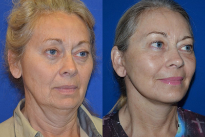 65-74 year old woman treated with Chin Implant - This woman came in with desires to rejuvenate her look. After having a consult, she elected to have the Facelift/Necklift procedure with laser resurfacing and a pre-jowl implant.