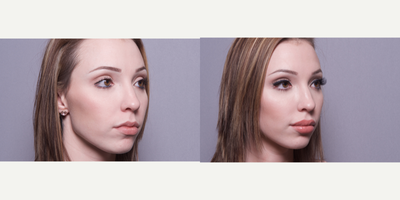 18-24 year old woman treated with Juvederm - 18-24 year old woman treated with Juvederm