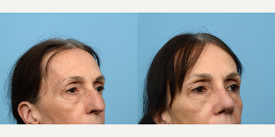 55-64 year old woman treated with Septoplasty - Rhinoplasty procedures are not exclusive to patients in their teens and twenties many patients make the decision to undergo nose surgery later in life, as was the case for this 59-year-old patient. Seven weeks post-op, she is grateful for the beautiful new nose Dr. Wise was able to craft for her.