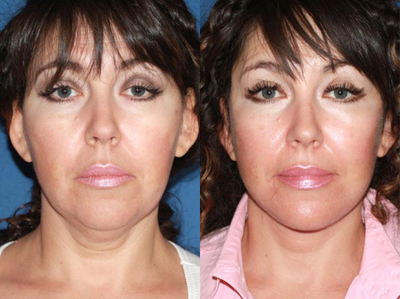 55-64 year old woman treated with Facelift - This patient presents with concerns of sagging neck skin and jowls. Good skin quality full cheeks make her an excelent candidate for facial rejuvenation. Face and neck lift was performed to restore the contour of the neck and jawline resulting in a significantly rejuvenated appearance.