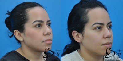 25-34 year old woman treated with Alarplasty - 25-34 year old woman treated with Alarplasty using weir excisions