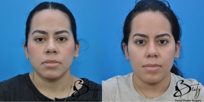 25-34 year old woman treated with Alarplasty - 25-34 year old woman treated with Alarplasty using weir excisions