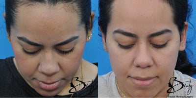 25-34 year old woman treated with Alarplasty - 25-34 year old woman treated with Alarplasty using weir excisions