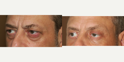 45-54 year old man treated with Eyelid Surgery - upper and lower blepharoplasty
