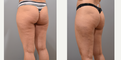 Cellulite reduction with Aveli - This lovely patient was bothered by cellulite in the back of her thighs and buttock region. She was interested in reducing the cellulite so I performed a cellulite reduction procedure using Aveli. At one month post-procedure, there is significant improvement. What is cellulite?Cellulite is the dimpled appearance of skin that is typically seen in the back of the thighs and buttock area.What causes cellulite?Thickened fibrous tissue that connects muscle fascia to the skin causes depressions on the surface of the skin. Who gets cellulite?Approximately 80-90% of adult women have cellulite to some extent.How is cellulite treated?Release of the fibrous tissue causing the dimpling is an effective way to reduce or improve the appearance of cellulite.What is Aveli?Aveli is a special device that safely and effectively releases the tethering causing cellulite, precisely where there is dimpling of skin.Who is a good candidate?Patients with mild to moderate cellulite without significant skin laxity or extra skin is an ideal candidate for cellulite reduction with Aveli.How long does it take?Depending on how many areas that need to be treated, it can take 1-2 hours with local anesthesia.What is the down time?Recovery is less than a week. Swelling and bruising is to be expected after the procedure. Compression garments should be worn to help with swelling and recovery.Photographs are posted with permission from patient.