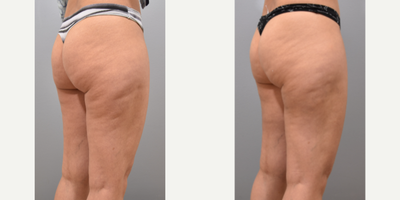 Cellulite reduction with Aveli - This lovely patient was bothered by cellulite in the back of her thighs and buttock region. She was interested in reducing the cellulite so I performed a cellulite reduction procedure using Aveli. At one month post-procedure, there is significant improvement. What is cellulite?Cellulite is the dimpled appearance of skin that is typically seen in the back of the thighs and buttock area.What causes cellulite?Thickened fibrous tissue that connects muscle fascia to the skin causes depressions on the surface of the skin. Who gets cellulite?Approximately 80-90% of adult women have cellulite to some extent.How is cellulite treated?Release of the fibrous tissue causing the dimpling is an effective way to reduce or improve the appearance of cellulite.What is Aveli?Aveli is a special device that safely and effectively releases the tethering causing cellulite, precisely where there is dimpling of skin.Who is a good candidate?Patients with mild to moderate cellulite without significant skin laxity or extra skin is an ideal candidate for cellulite reduction with Aveli.How long does it take?Depending on how many areas that need to be treated, it can take 1-2 hours with local anesthesia.What is the down time?Recovery is less than a week. Swelling and bruising is to be expected after the procedure. Compression garments should be worn to help with swelling and recovery.Photographs are posted with permission from patient.